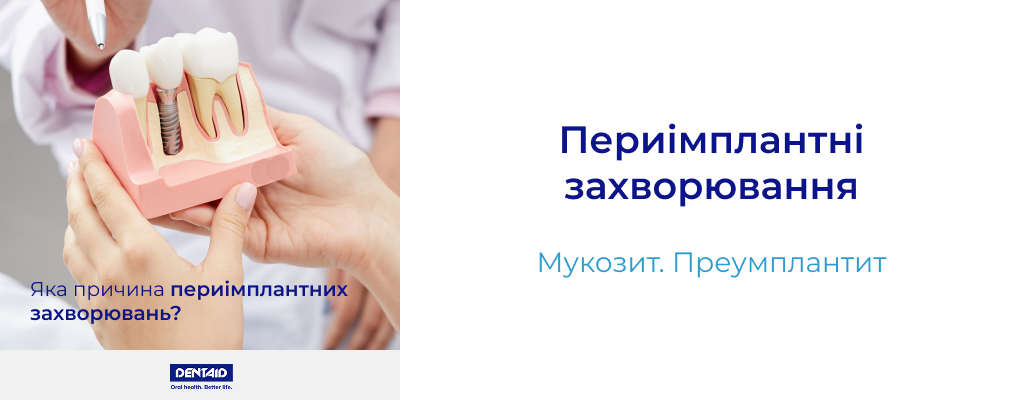 Периімплантні захворювання Периімплантний мукозит. Периімплантит