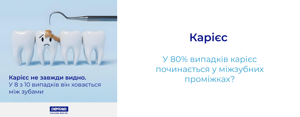 Карієс У 80% випадків карієс починається у міжзубних проміжках
